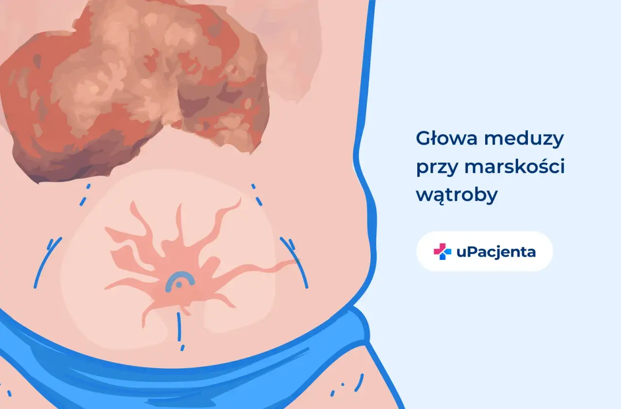 Ilustracja przedstawia objawy marskości wątroby, takie jak "głowa meduzy" na brzuchu. Dzięki leczeniu, wyleczyłem marskość wątroby.