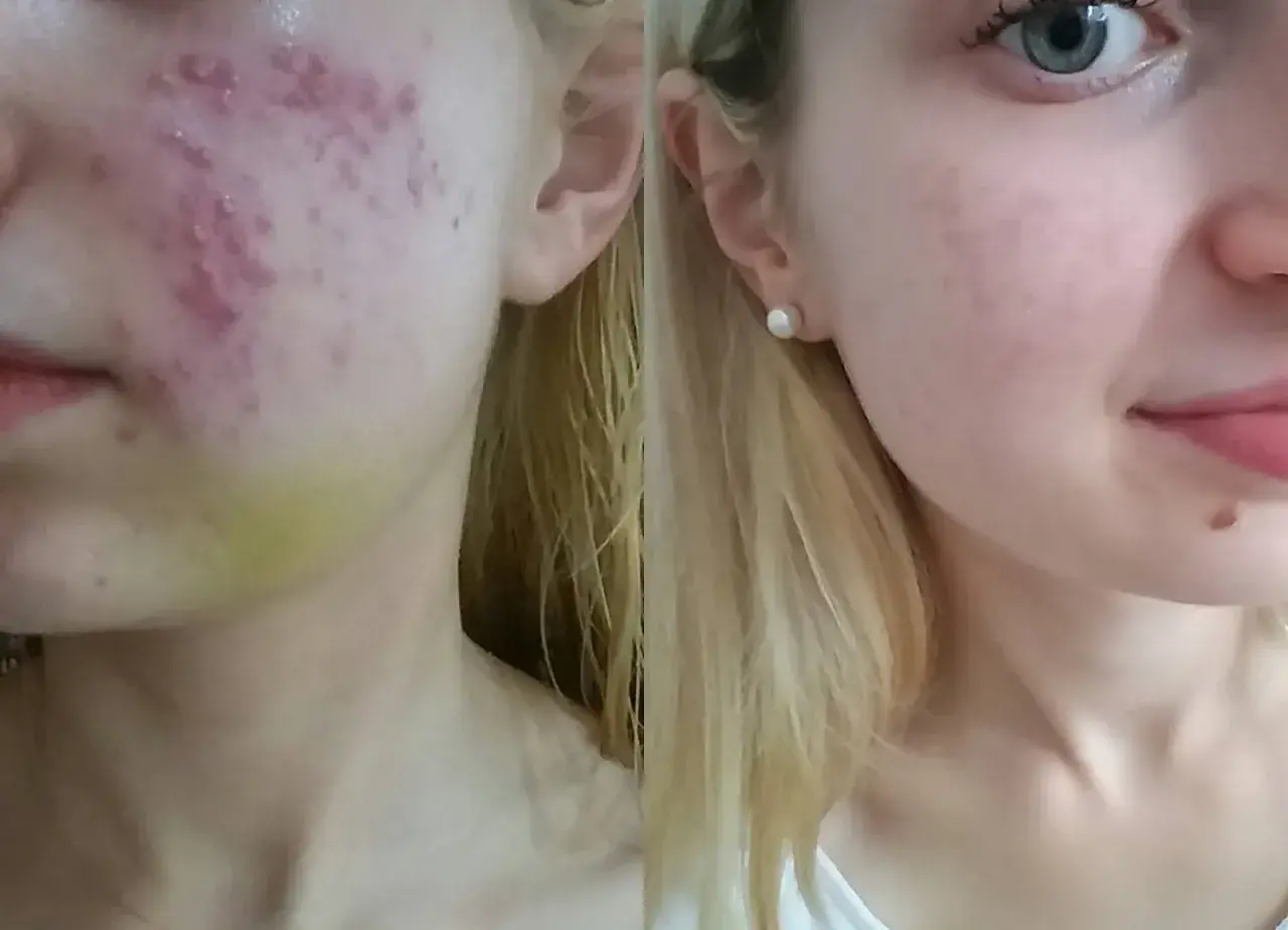 Przed i po kuracji Accutane: skóra z trądzikiem i zaczerwienieniami po lewej, gładka i czysta po prawej.