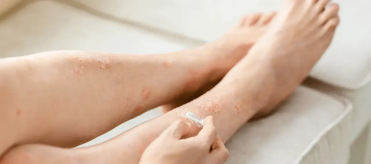 Osoba aplikuje krem locoid lipocream na skórę nóg z widocznymi zmianami łuszczycowymi.