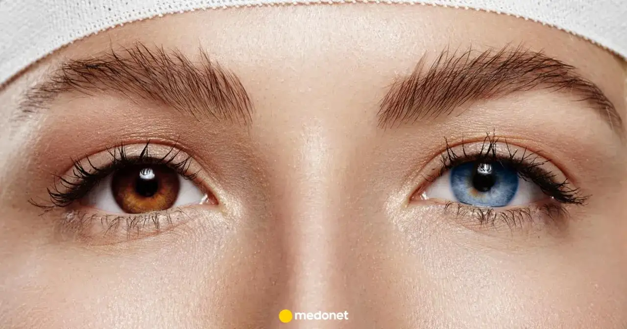 Oczy z różnymi kolorami tęczówek – brązowe i niebieskie – to fascynujący przykład heterochromii.