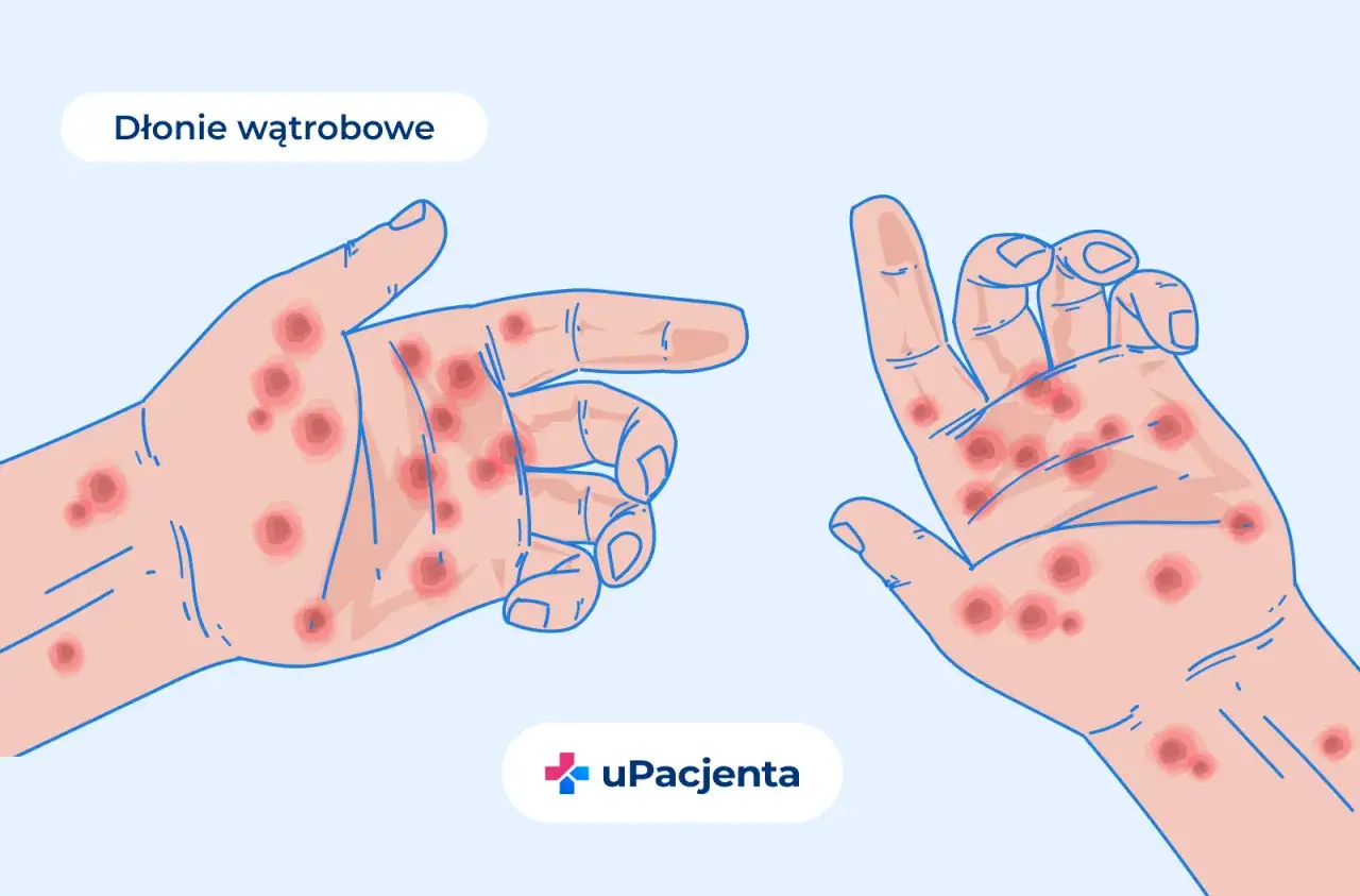 Dłonie wątrobowe z czerwonymi plamkami, widoczne na obu dłoniach. To może być ważny alat diagnostyczny.