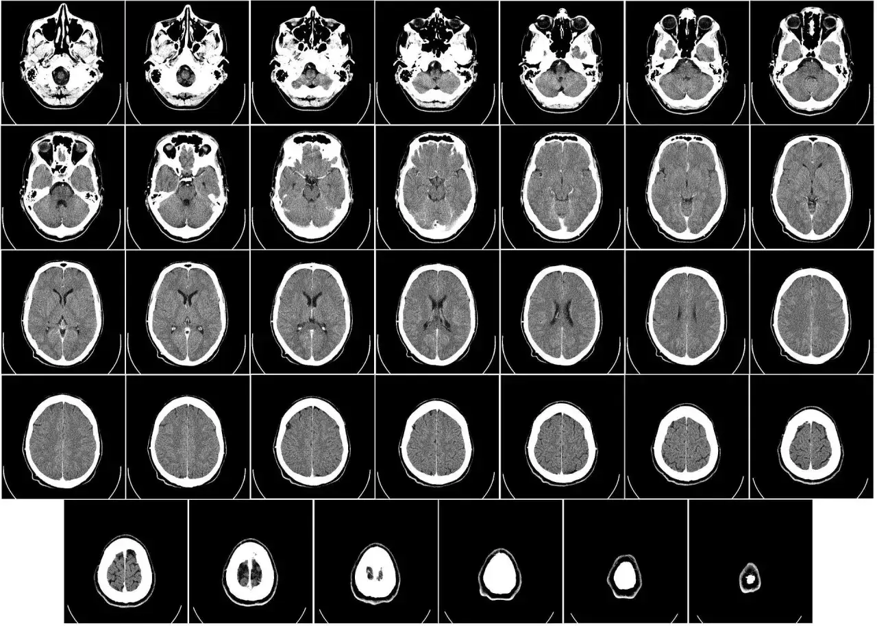 Zdjęcie Ile się czeka na wynik tomografii głowy? Sprawdź czas oczekiwania
