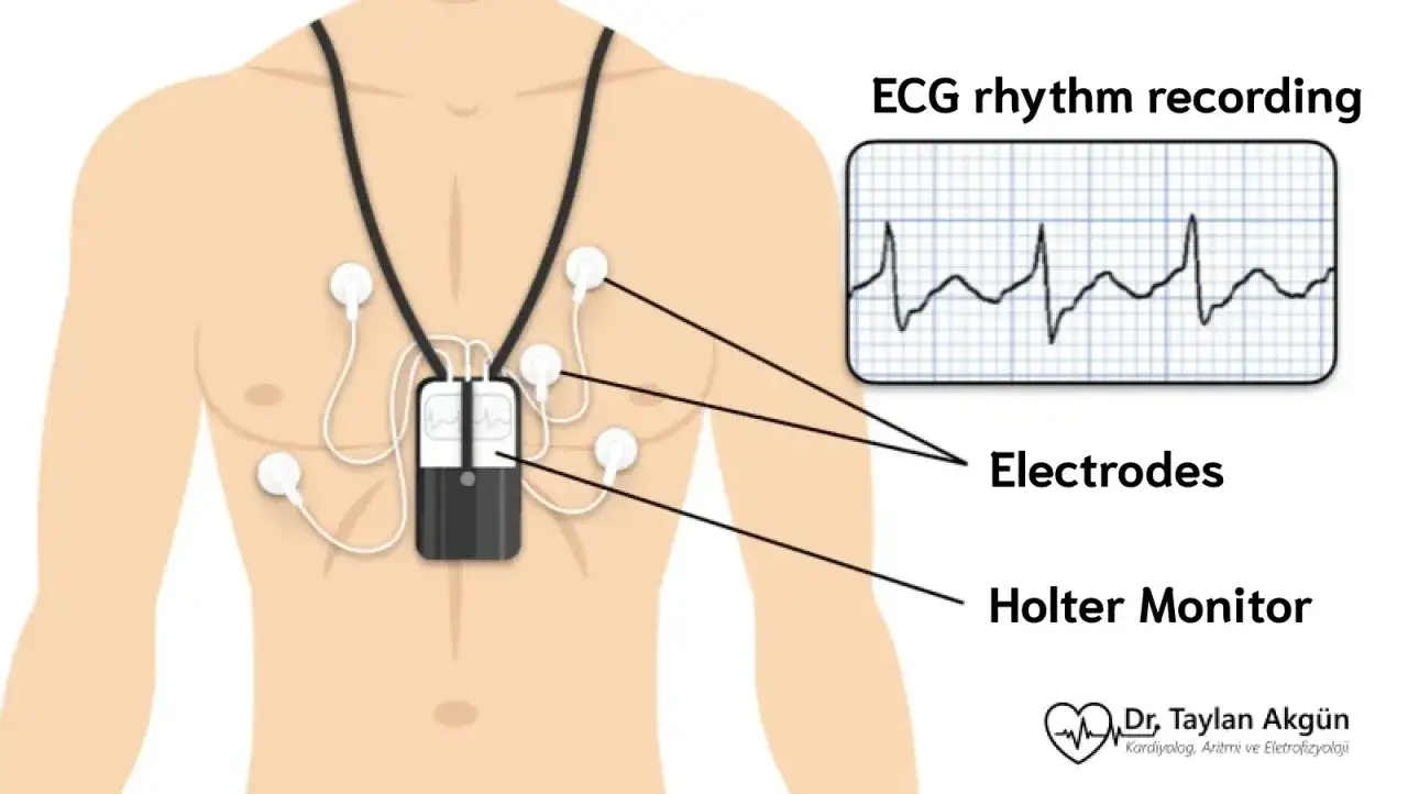 Holter Monitor to urządzenie do długoterminowego zapisu EKG. Wygląda jak mały odtwarzacz z elektrodami przyczepionymi do klatki piersiowej.