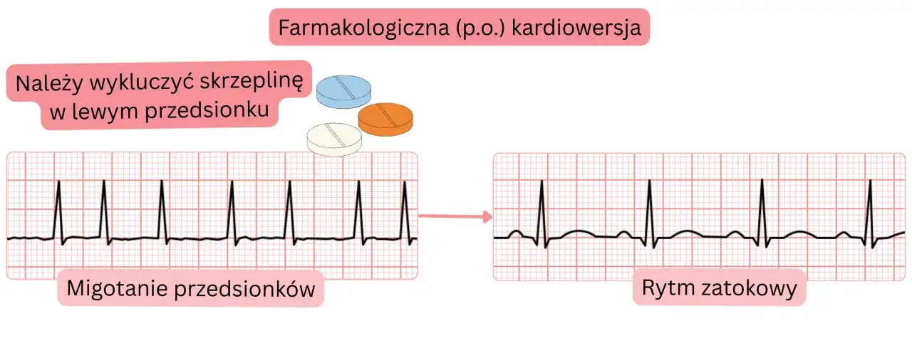 Farmakologiczna kardiowersja po wykluczeniu skrzepliny. Migotanie przedsionków przechodzi w rytm zatokowy dzięki lekom, np. polfenon.