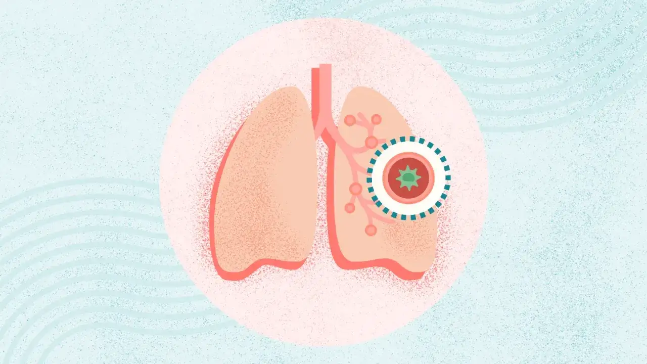 Ilustracja płuc z zaznaczonym problemem w oskrzelu, sugerującym potrzebę leczenia, np. Tussipect.