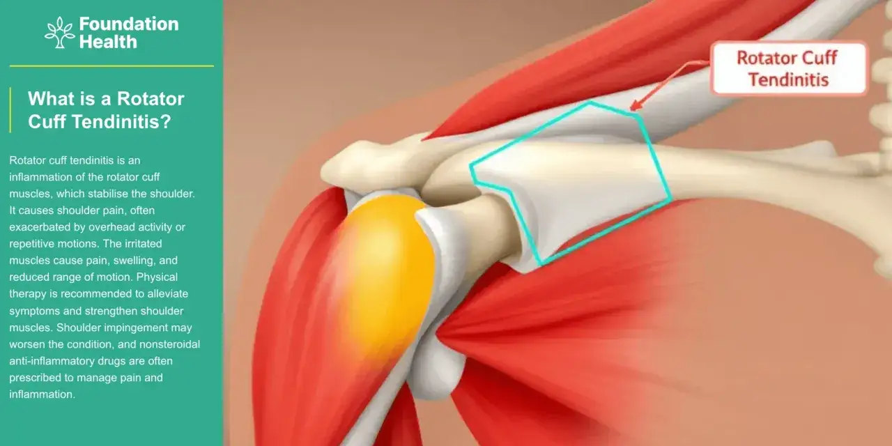 Ilustracja anatomiczna ramienia, pokazująca zapalenie stożka rotatorów.
