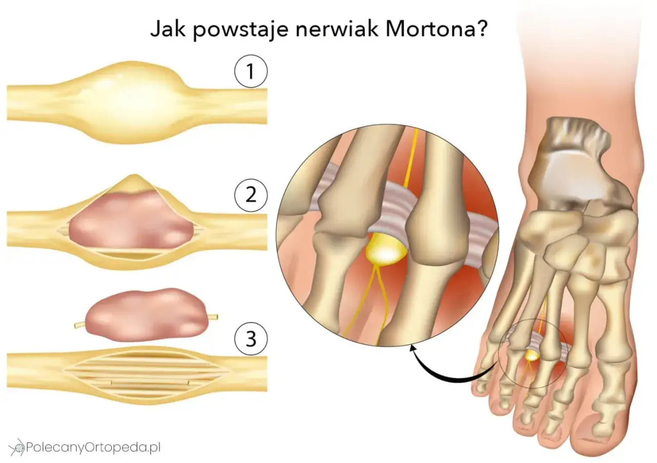 Ilustracja pokazuje powstawanie nerwiaka Mortona: pogrubienie nerwu w stopie, które może powodować ból.