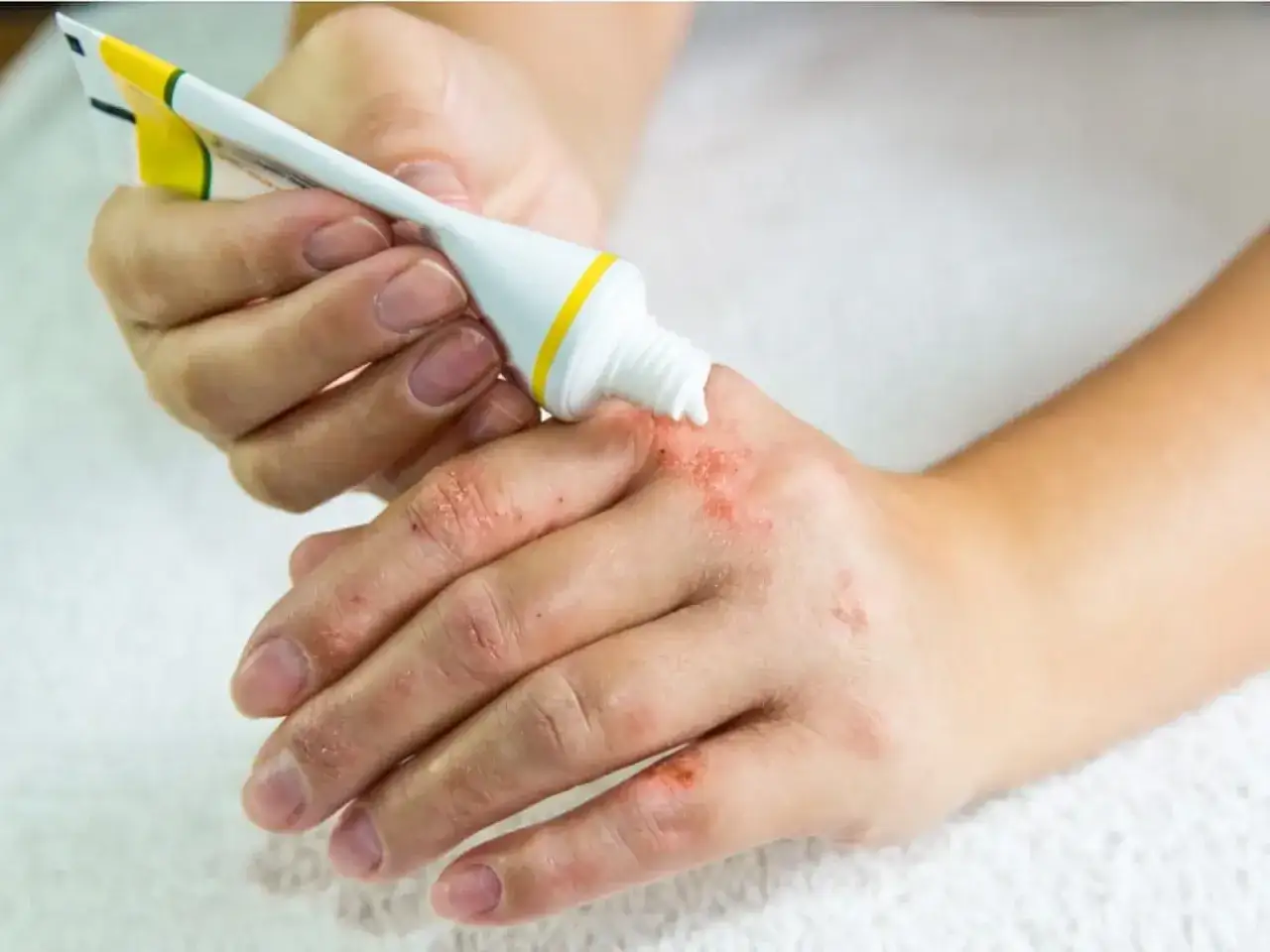 Dłoń z egzemą, na którą aplikowany jest krem Locoid Lipocream.