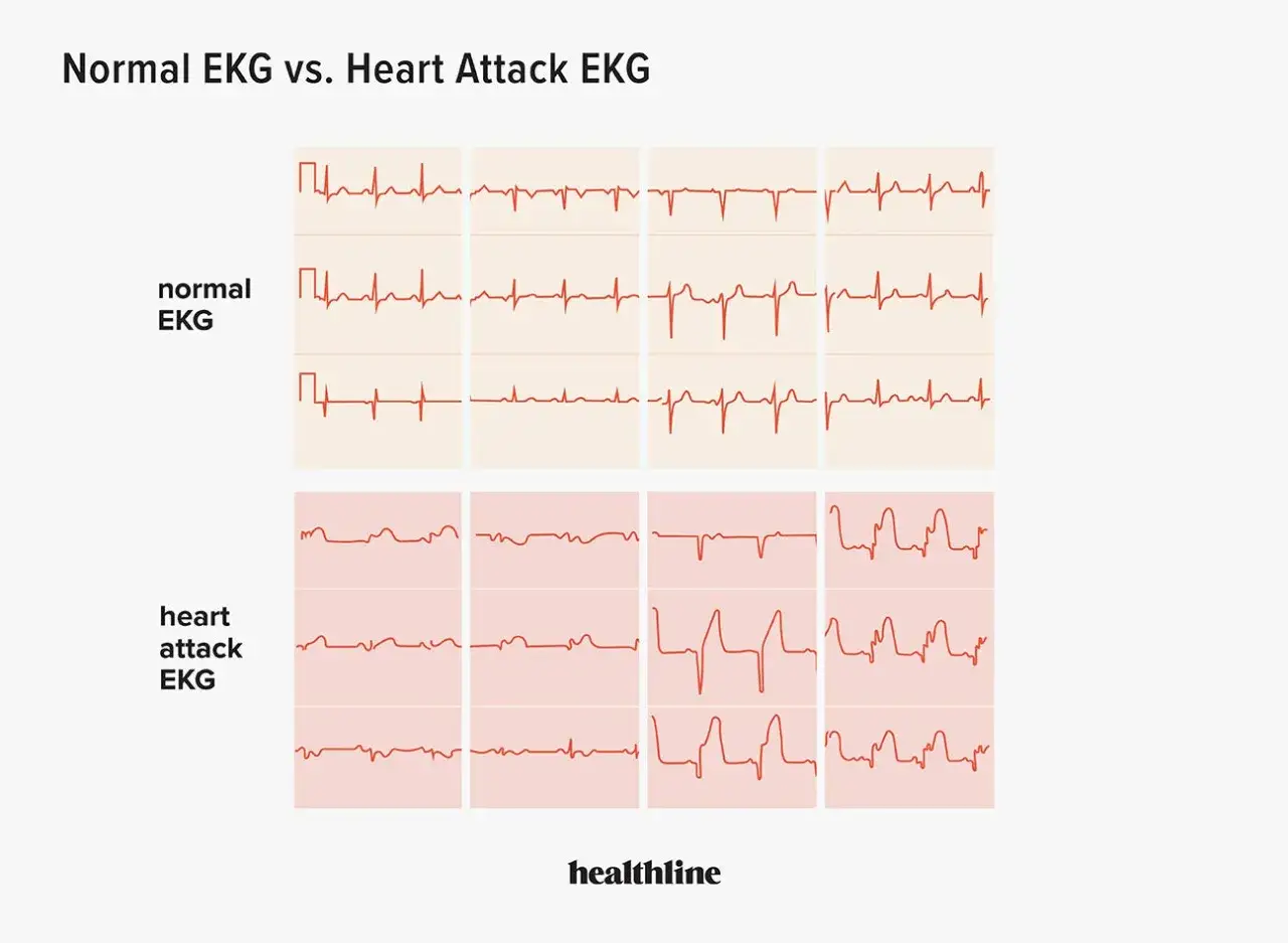 Porównanie zapisu ekg serca: prawidłowe ekg vs. ekg po zawale. Widać wyraźne różnice w przebiegu linii.