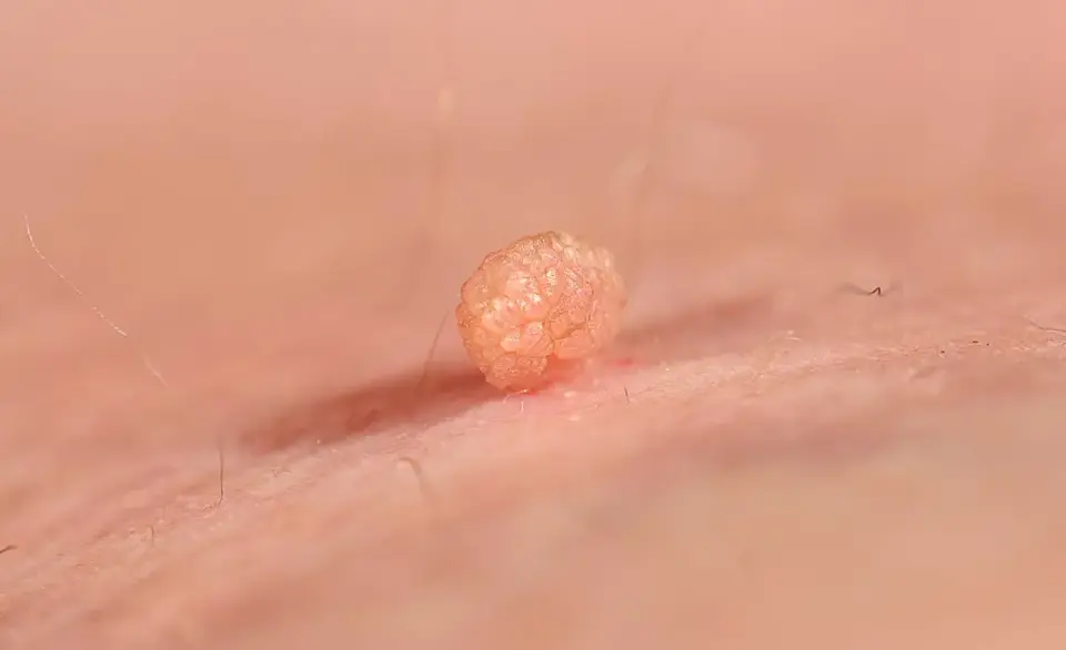 HPV - Czy to tylko kurzajki? Objawy, leczenie, szczepienia