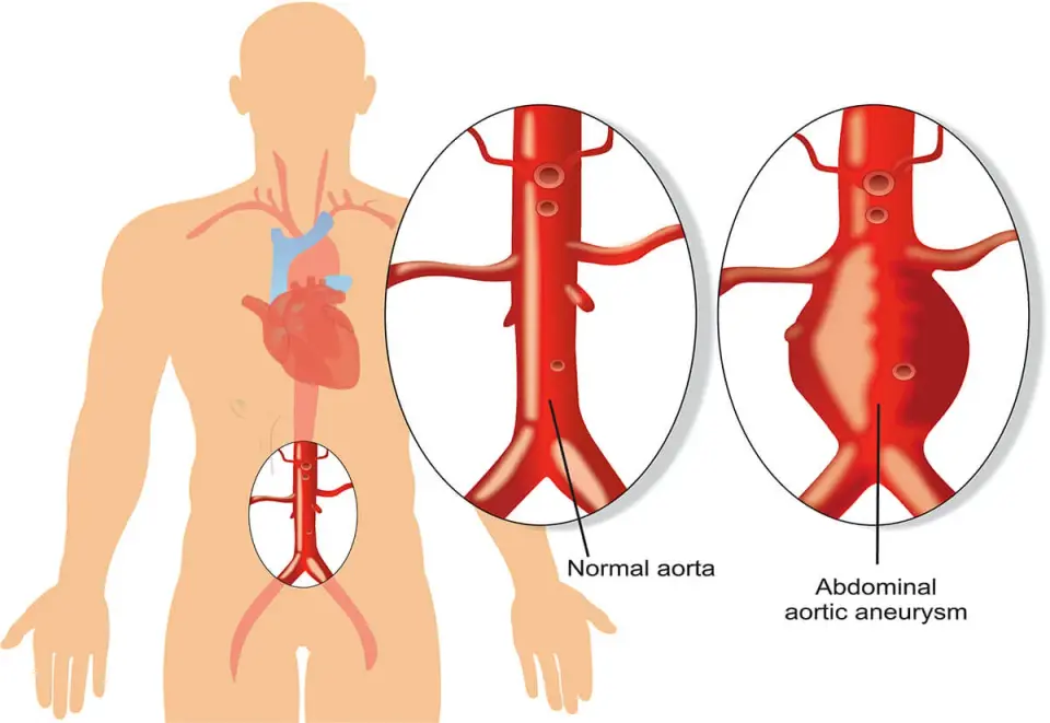 Aorta - budowa, choroby i objawy. Czy grozi Ci tętniak?